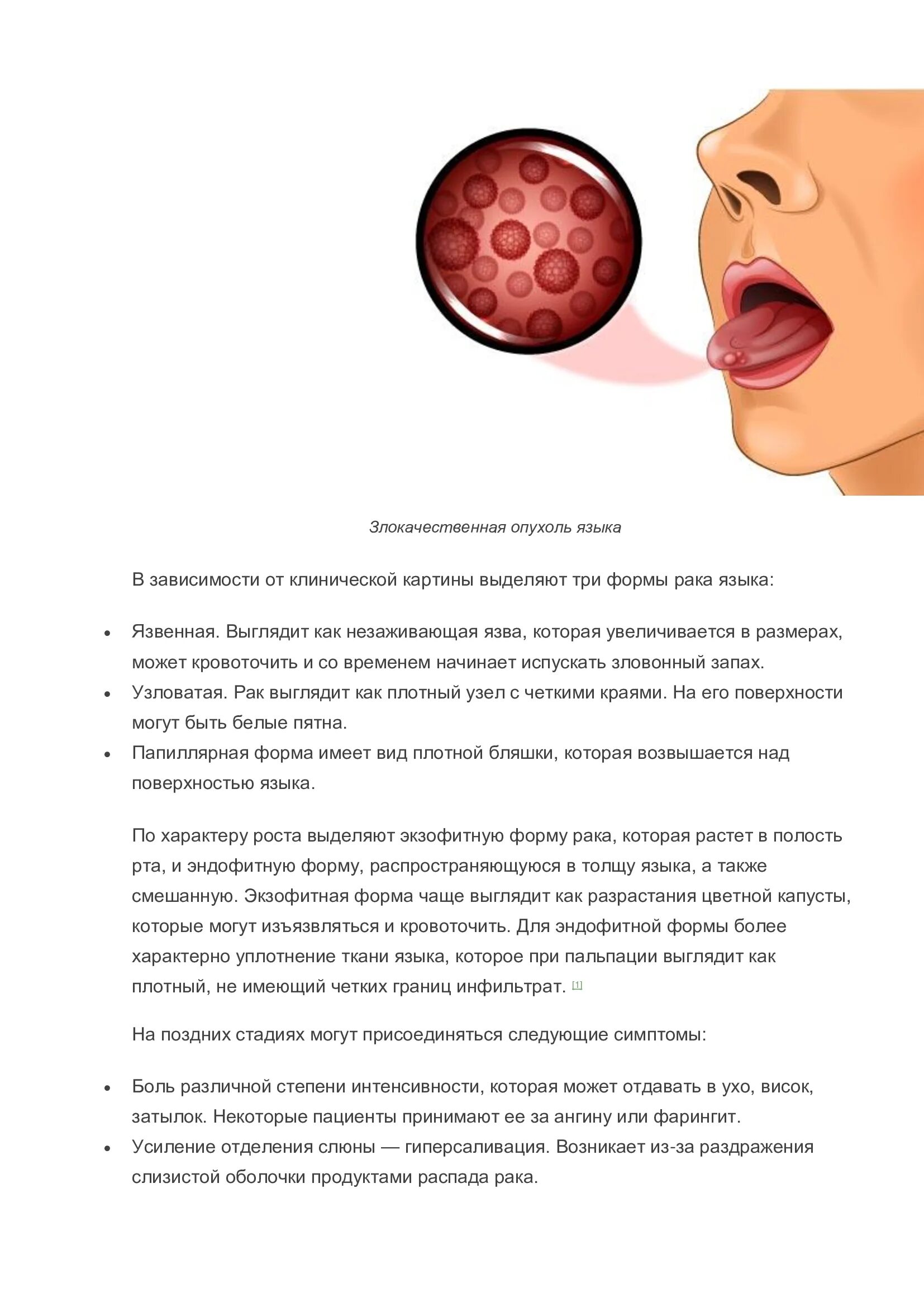 Плоскоклеточный рак языка фото симптомы и лечение РАК ЯЗЫКА