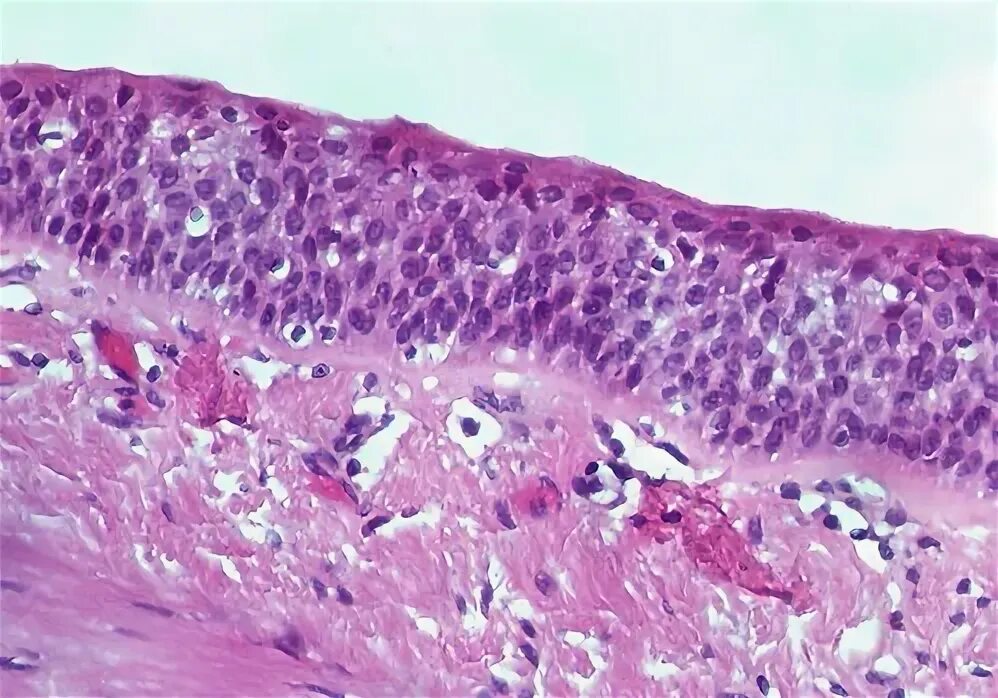 Плоскоклеточный рак языка фото симптомы и лечение Dr. Yale Rosen Atlas of Pulmonary Pathology Flickr