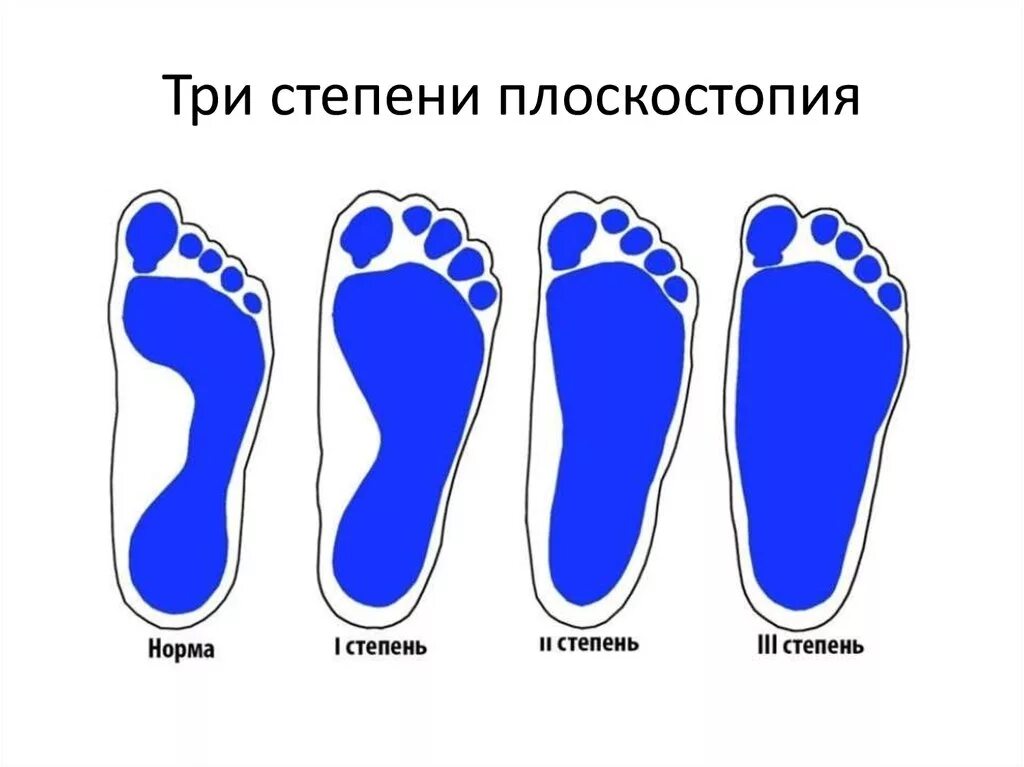 Плоскостопие симптомы фото Исследовательская работа на тему: "Плоскостопие и методы её лечения"