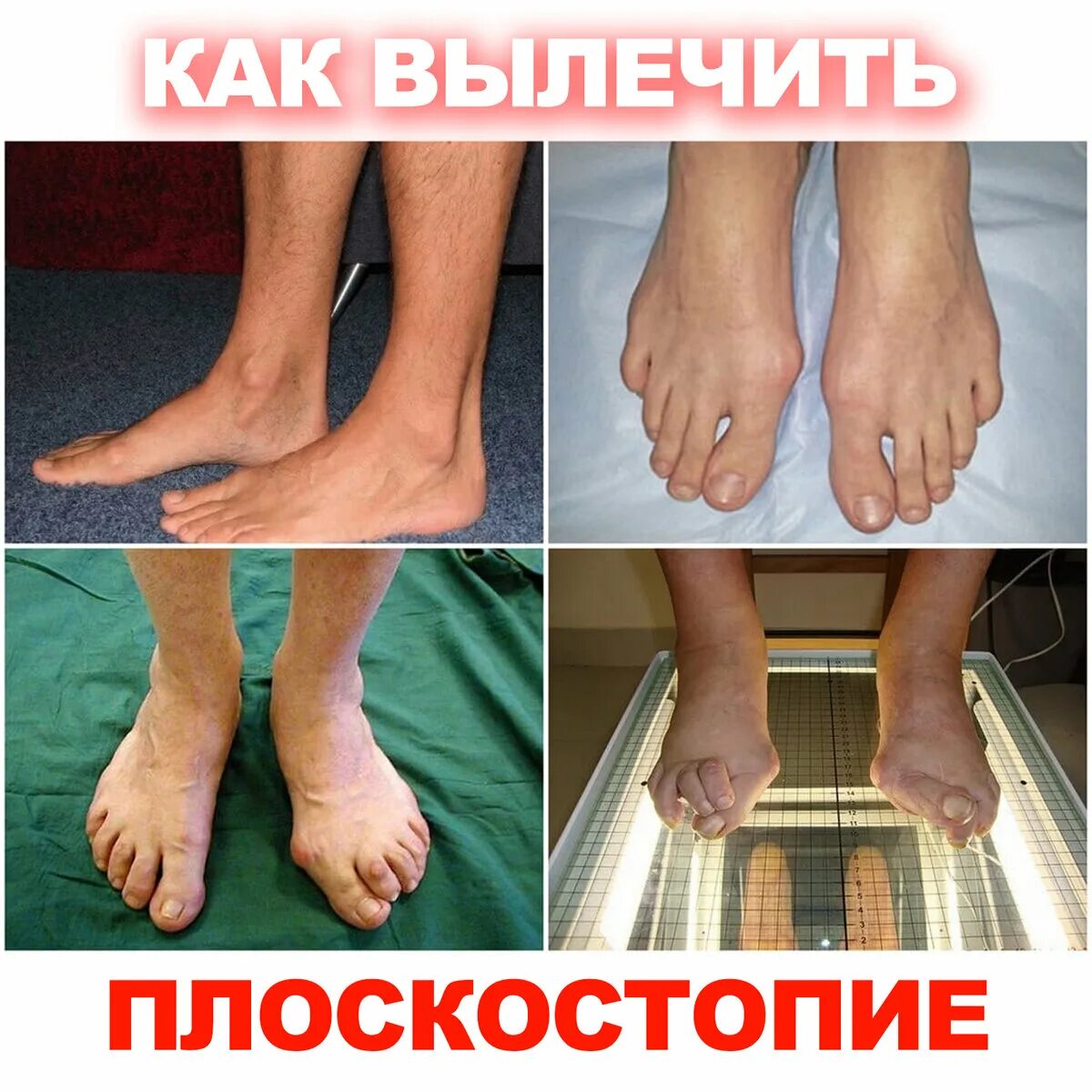 Плоскостопие симптомы фото Как выглядит плоскостопие фото