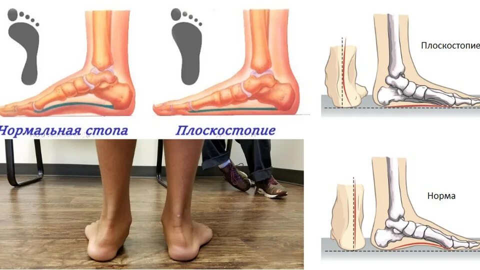 Плоскостопие симптомы фото Укрепляйте сердце, заботясь о ногах: 4 совета по улучшению функции нижних конечн