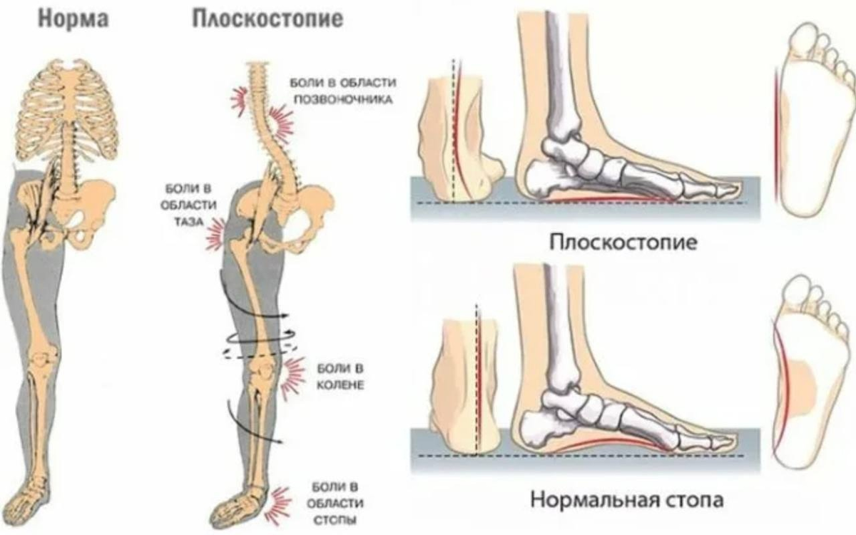Плоскостопие симптомы фото Сам Себе Ортопед: суть метода работы с плоскостопием Сам Себе Ортопед. Спб. Дзен