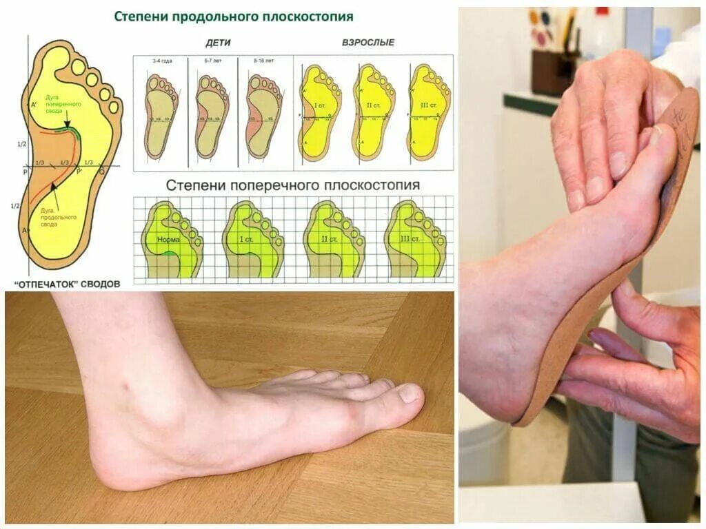 Плоскостопие симптомы фото Стельки ортопедические(специализированные) от плоскостопия!: Договорная ▷ Другая