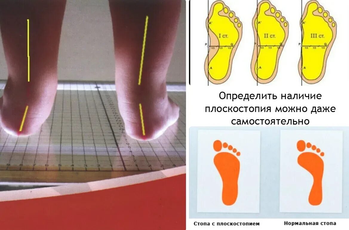 Плоскостопие симптомы фото Как бороться с плоскостопием у детей? Ответы на основные вопросы родителей О дет