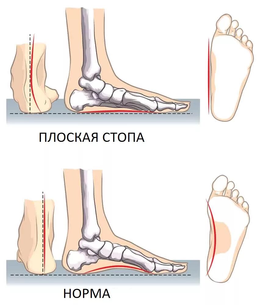 Плоскостопие симптомы фото Стопа Обувь INBLU. Официальный сайт
