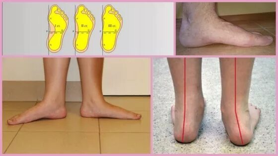 Плоскостопие симптомы фото Flat feet 2 degrees (longitudinal and transverse) signs, pictures, treatment