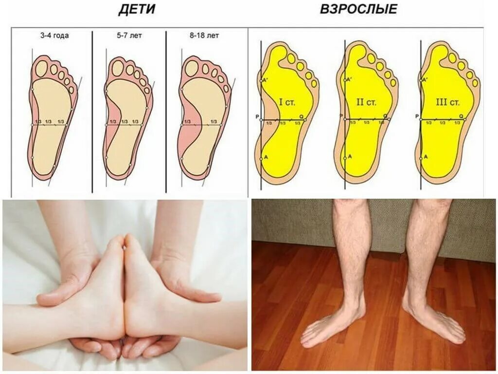 Плоскостопие симптомы у взрослых фото Деформация стопы