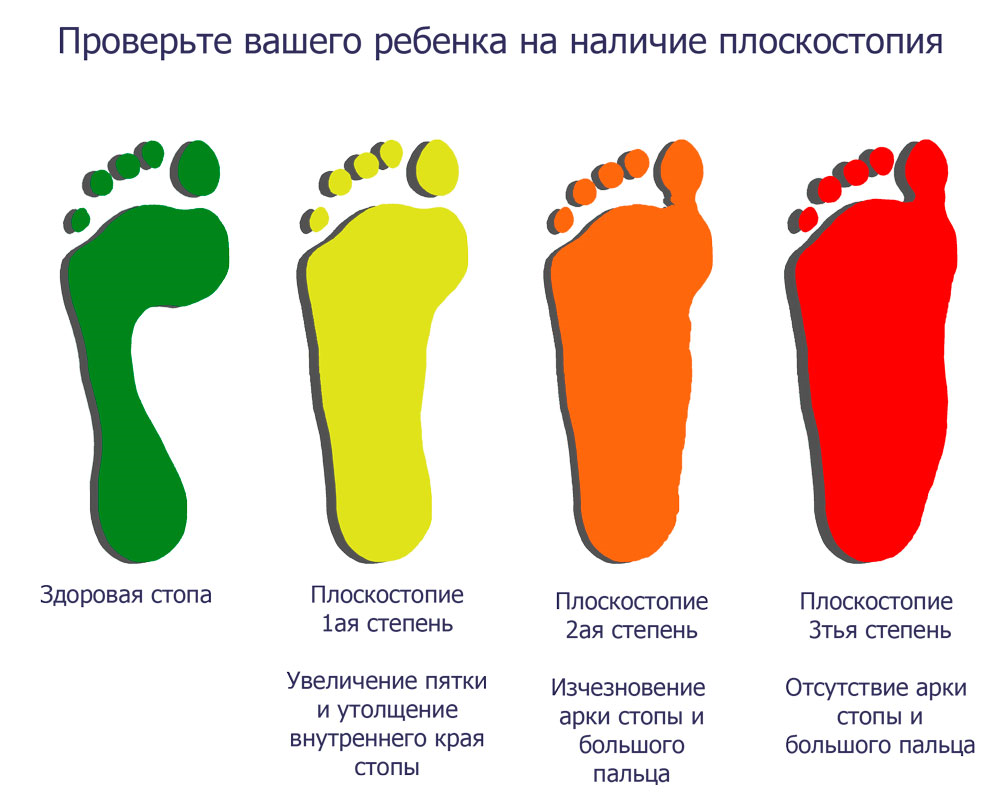 Плоскостопие симптомы у взрослых фото Как предупредить детское плоскостопие или справиться с ним в случае появления О 