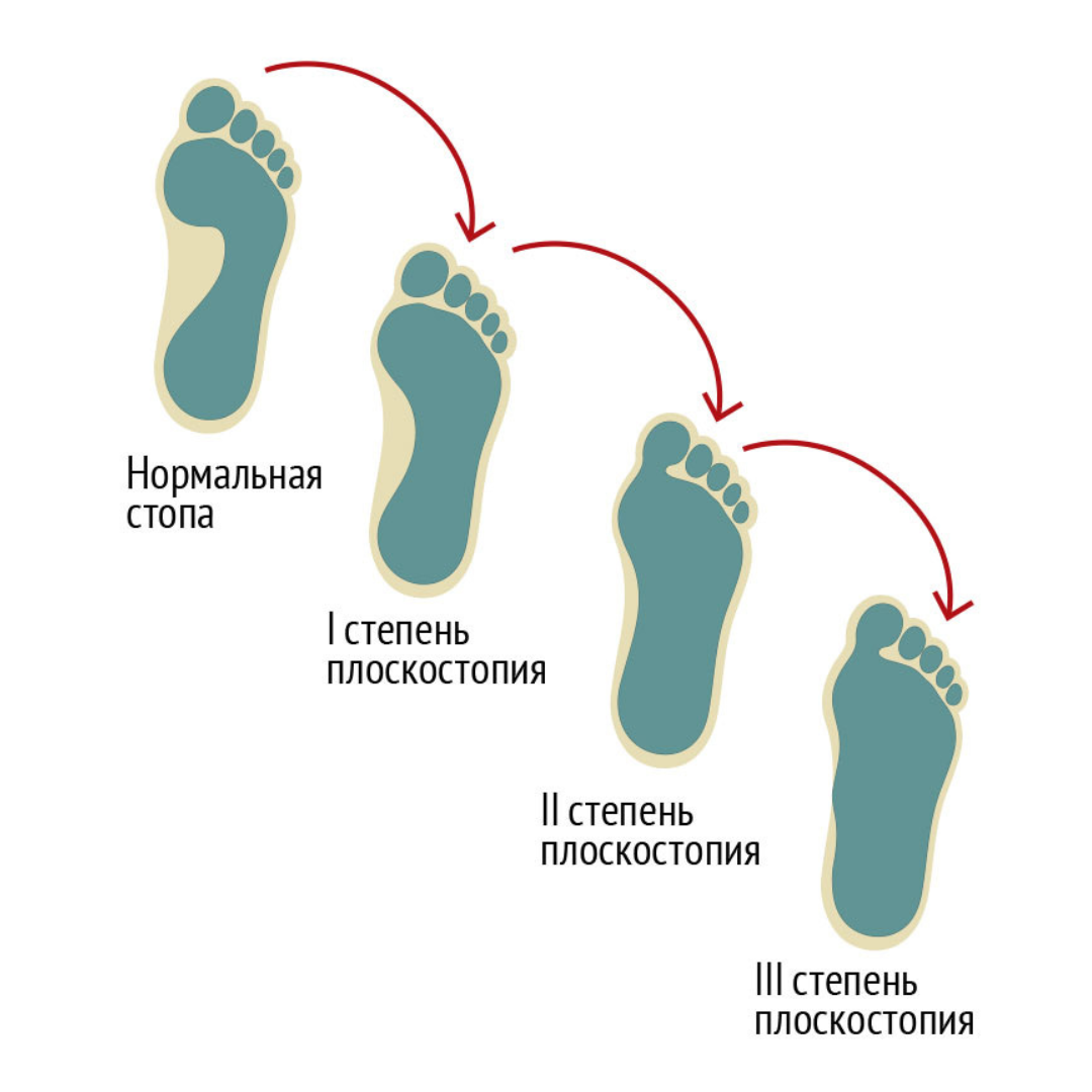 Плоскостопие симптомы у взрослых фото Тест на плоскостопие КИТ Клиника Ильи Труханова в Куркино Дзен