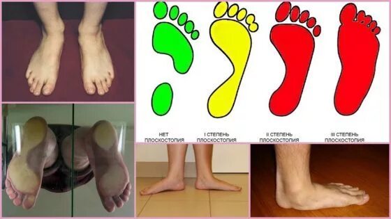 Плоскостопие симптомы у взрослых фото Types of flat feet in adults and children