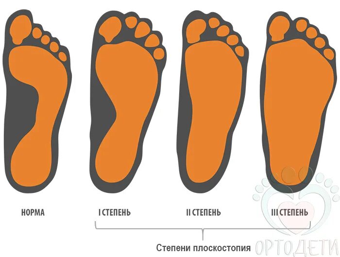 Плоскостопие симптомы у взрослых фото Комплекс лечебной гимнастики при плоскостопии Физическая культура в школе СОВРЕМ