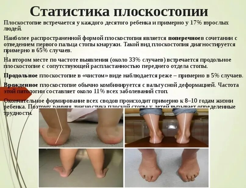 Плоскостопие симптомы у взрослых фото Плоскостопие врожденное или приобретенное: найдено 79 картинок