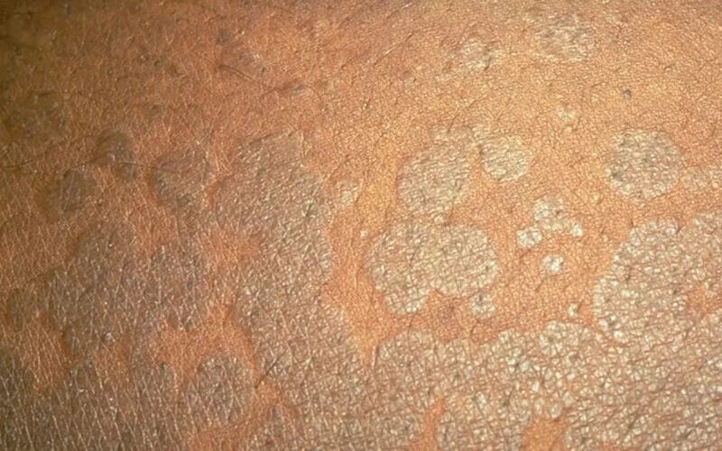 Пляжный лишай фото Как выглядит грибок на коже Медицинская эстетическая косметология
