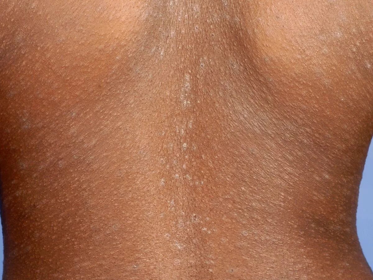 Пляжный лишай фото Pityriasis rosea (patientenfolder)