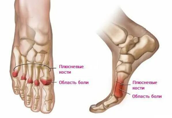 Плюсна стопы что это такое фото Болит большой палец на ноге где косточка