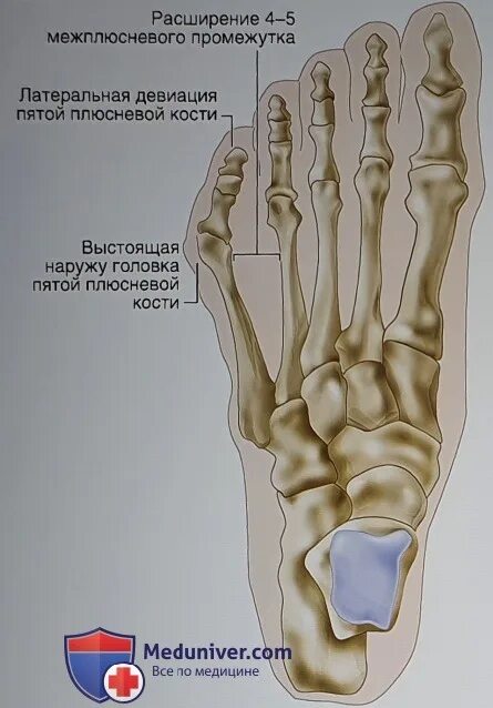 Плюсневая кость фото Показания для остеотомии пятой плюсневой кости при варусной деформации пятого па