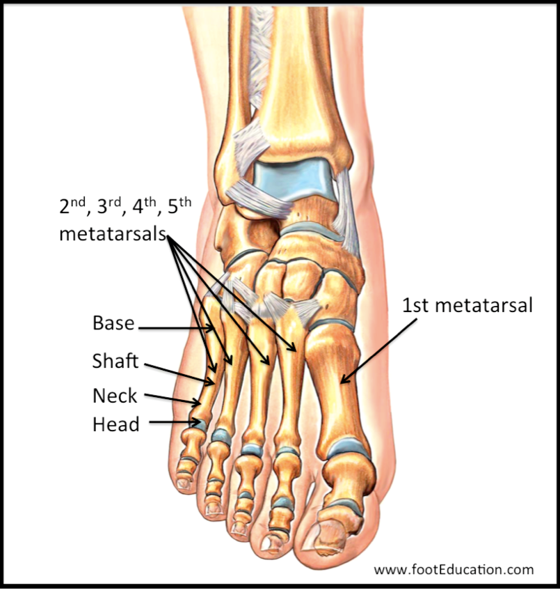 Плюсневая кость фото Metatarsal Fractures OrthoPaedia Header