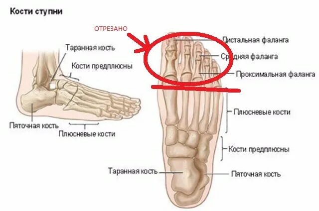 Плюсневая кость фото Остались осколки после операции - Вопрос ортопеду-травматологу - 03 Онлайн