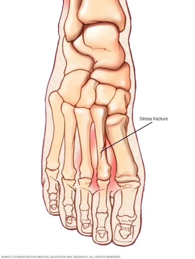 Плюсневая кость ноги фото Stress fracture - Mayo Clinic