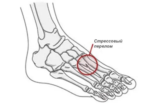 Плюсневая кость стопы где находится фото перелом Болезнь Дойчлендера - причины, симптомы, диагностика