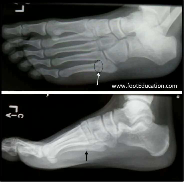 Плюсневая кость стопы где находится фото перелом 5th Metatarsal Base Fractures - FootEducation Avulsion fracture, Metatarsal frac