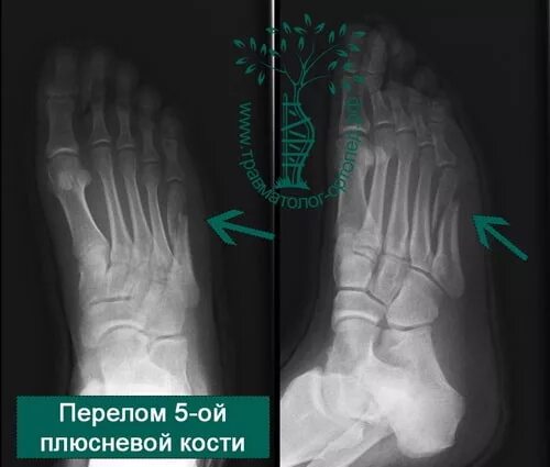 Плюсневая кость стопы где находится фото перелом Перелом плюсневых костей код по мкб: найдено 72 изображений