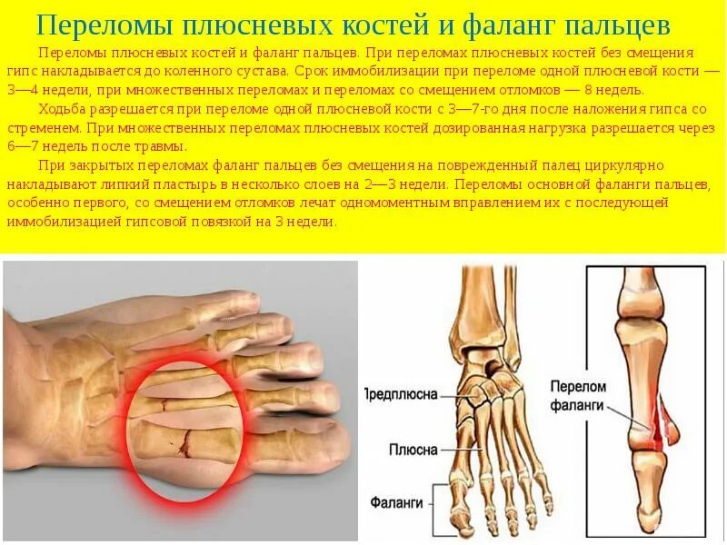 Плюсневая кость стопы где находится фото перелом Закрытый перелом основания