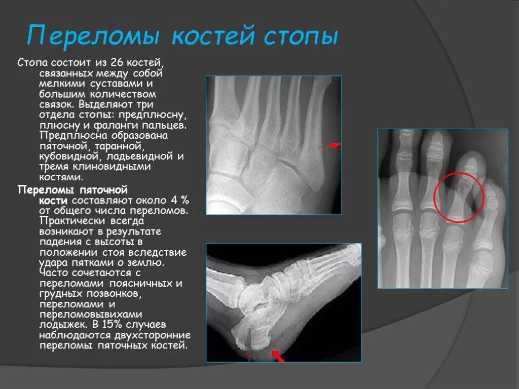 Плюсневая кость стопы где находится фото перелом Презентация "Переломы верхней и нижней конечности" - скачать проект