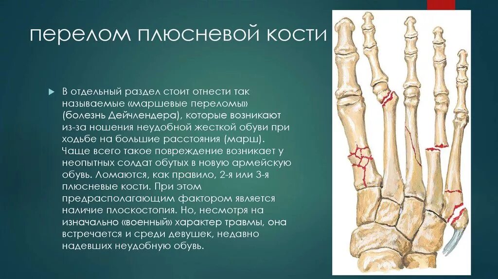 Плюсневая кость стопы где находится фото перелом Сколько заживает плюсневая кость стопы - найдено 88 картинок