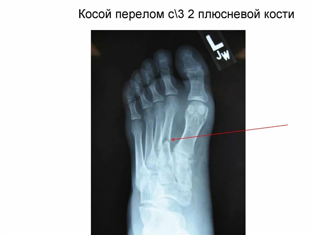 Плюсневая кость стопы где находится фото перелом Картинки ПЛЮСНЕВАЯ КОСТЬ СТОПЫ ПЕРЕЛОМ У РЕБЕНКА