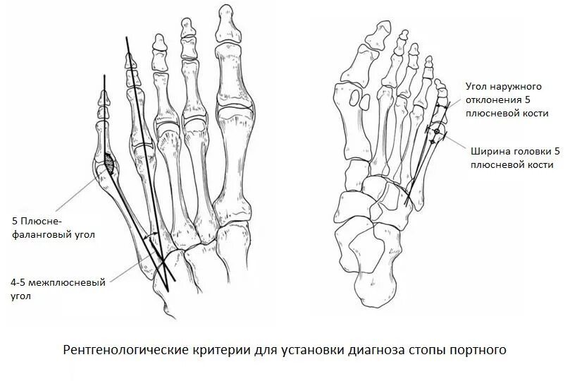 Плюсневые кости стопы фото Стопа портного (косточка на мизинце) Фото до и после, операция, отзывы, лечение,