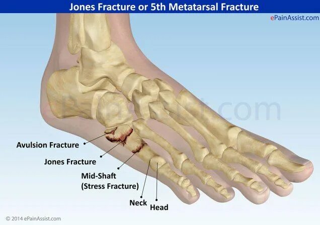 Плюсневые кости стопы фото jones fractuur - Yahoo Image Search Results