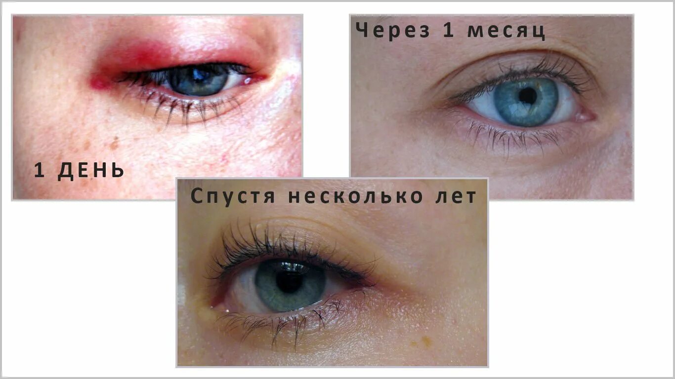 Плюсы и минусы татуажа межреснички Межресничка по дням: найдено 89 картинок