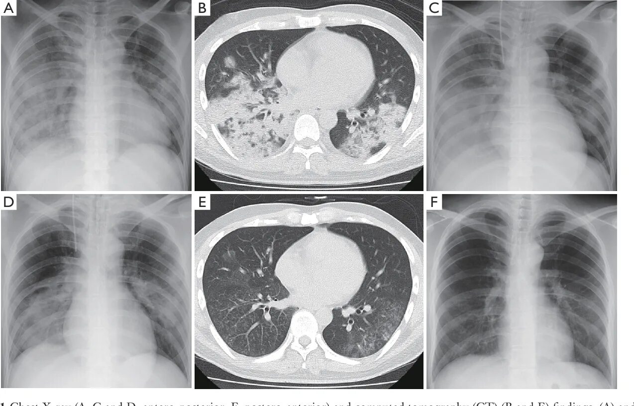 Пневмония как выглядит фото Acute respiratory distress syndrome caused by Mycoplasma pneumoniae without elev