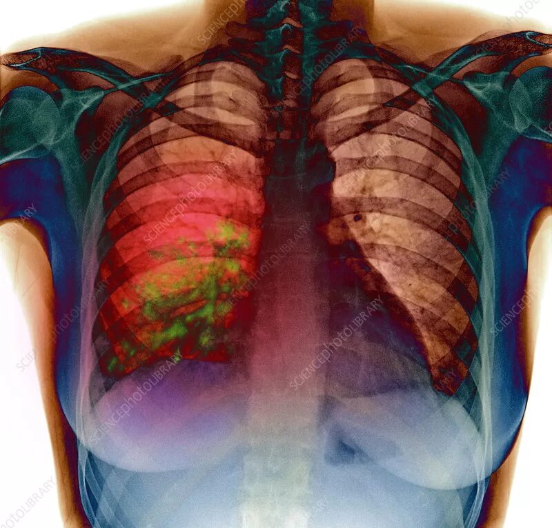 Пневмония как выглядит фото Pneumonia, X-ray - Stock Image - M240/0508 - Science Photo Library