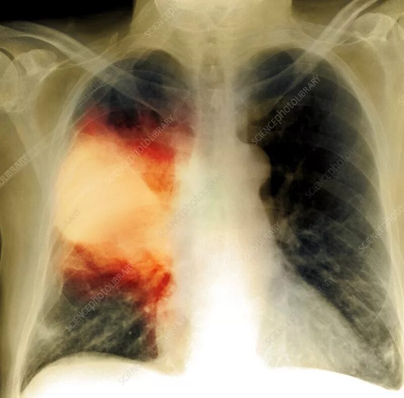 Пневмония как выглядит фото Pneumonia, X-ray - Stock Image - M240/0779 - Science Photo Library