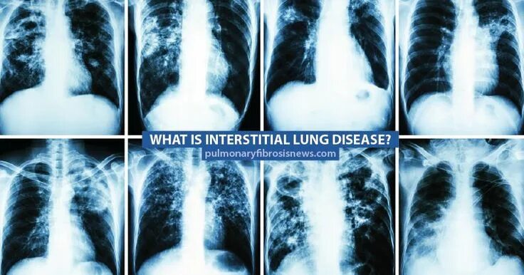 Пневмония как выглядит фото Pin on Pulmonary Fibrosis