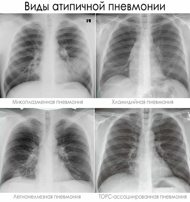 Пневмония как выглядит фото Рентгенологическая картина пневмонии у детей