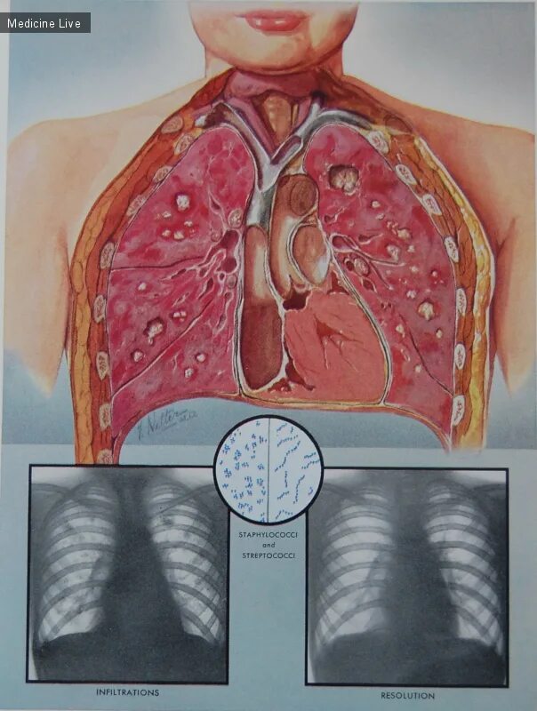 Пневмония как выглядит фото Frank H. Netter - The CIBA collection of medical illustration - Легкие / Красивы