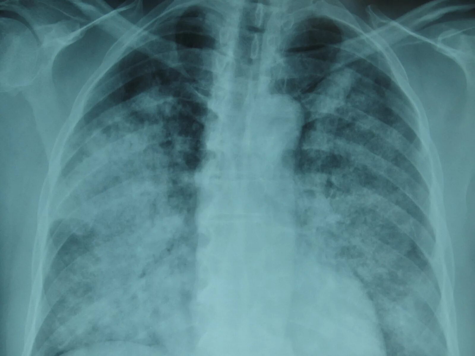 Пневмония как выглядит фото Jan British Journal of Medical Practitioners