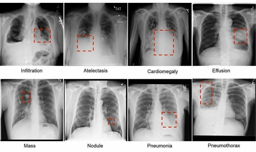Пневмония как выглядит фото Pin on Terminologie médicale Radiology, Radiology tech, Radiology imaging