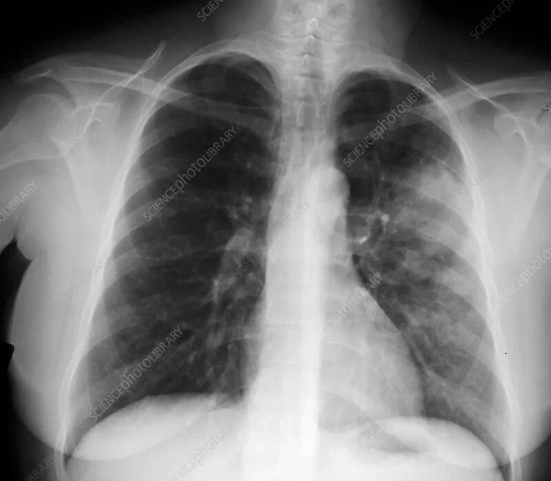 Пневмония как выглядит фото Walking Pneumonia - Stock Image - C007/5588 - Science Photo Library