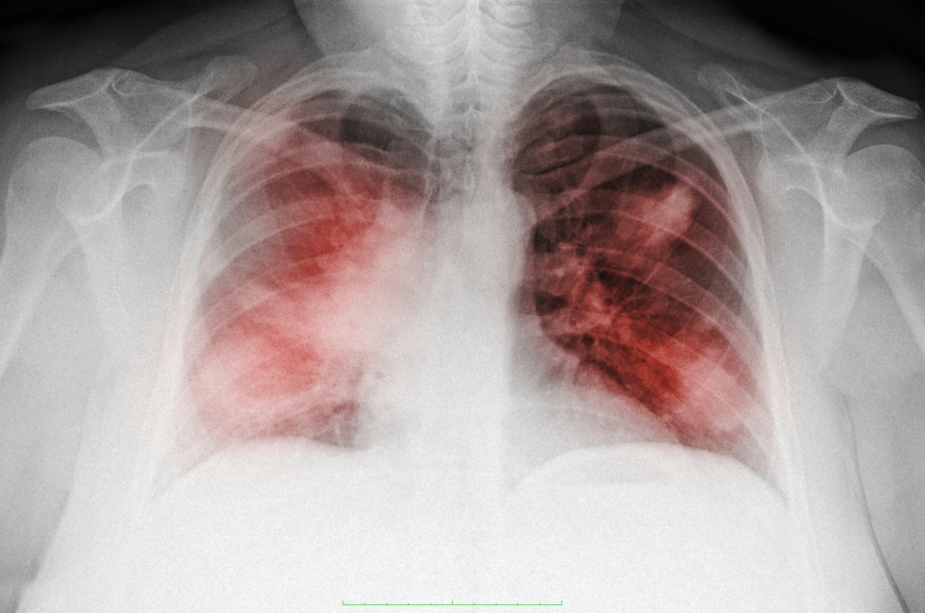 Пневмония как выглядит фото What is septicaemia? Is it the same as sepsis and what are the signs and symptom