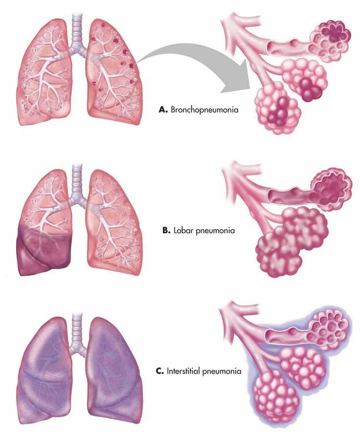 Пневмония как выглядит фото Biology Forums - For All Your Science Needs - (A) Bronchopneumonia with localize