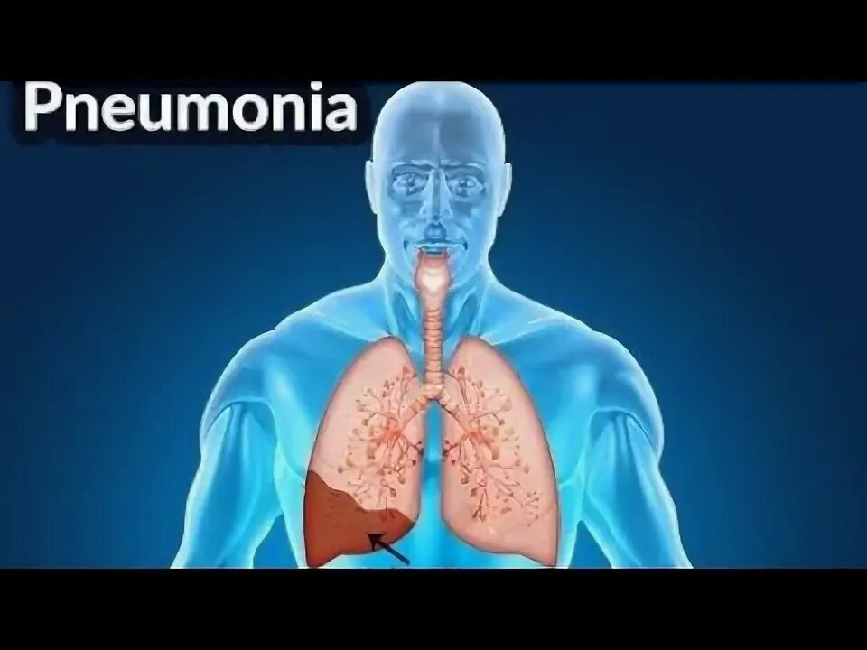 Пневмония как выглядит фото What is Pneumonia ? Overview - YouTube