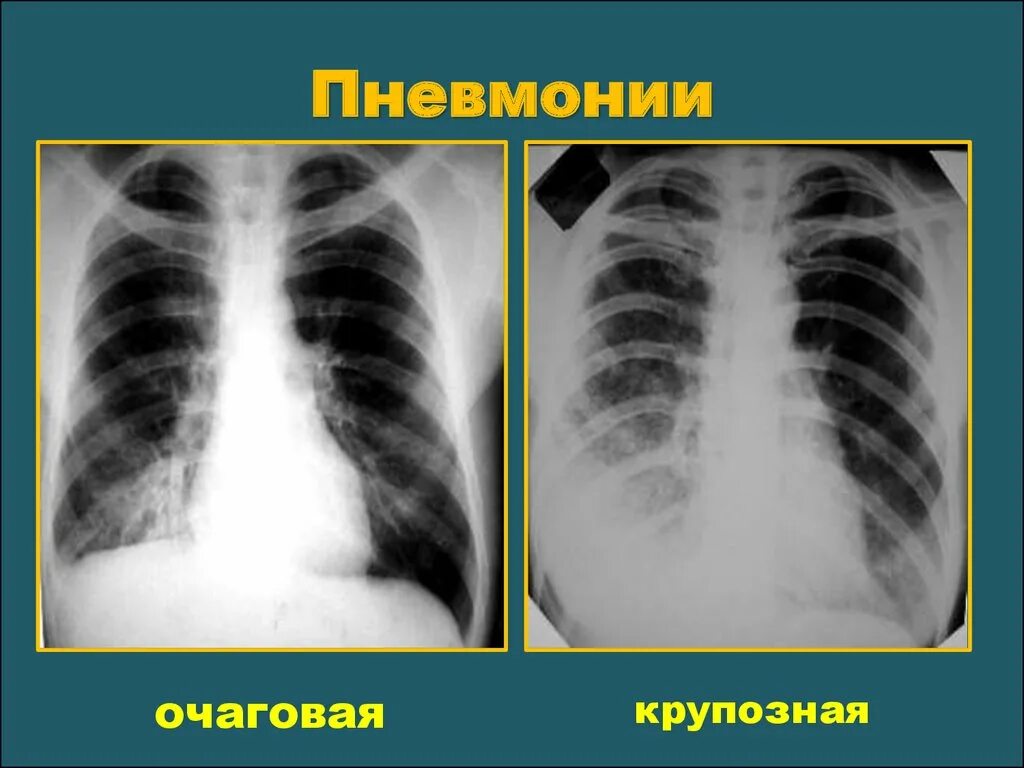 Пневмония как выглядит фото Флюорография на ранней стадии