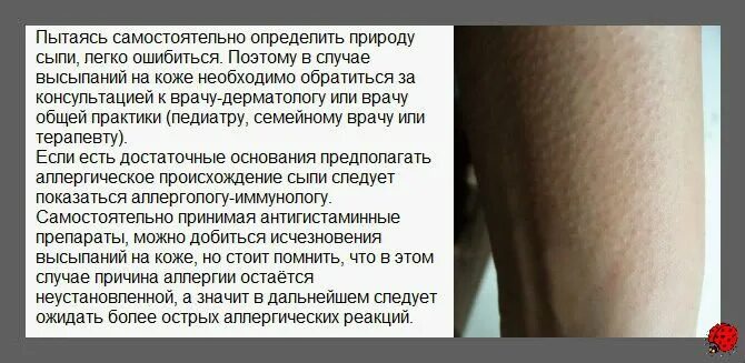 По фото определить сыпь на коже Красные прыщики на руках чешутся, высыпания на пальцах рук, выше локтя. Причины