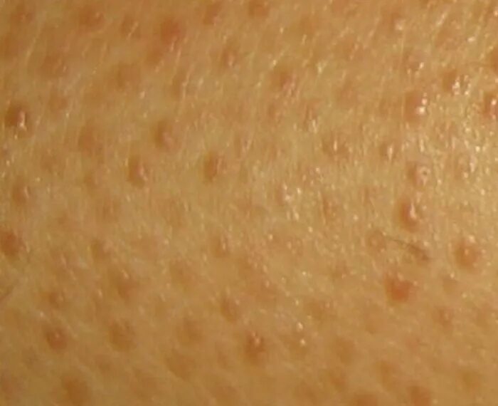 По фото определить сыпь на коже Itchy bumps on cliterus