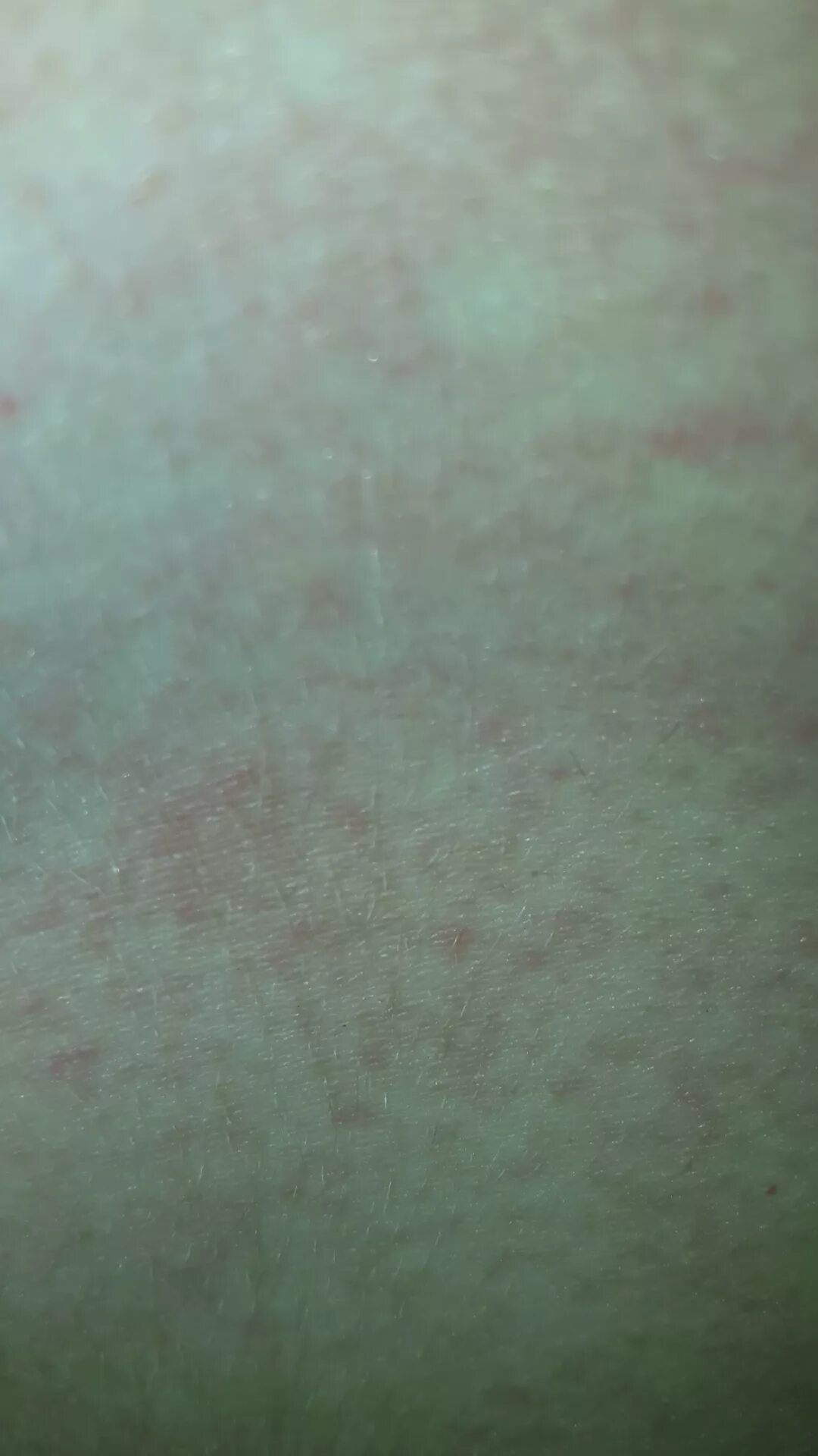 По фото определить сыпь на коже Ответы Mail.ru: Сыпь на груди, животе. Чешется не сильно, температуры нет. На чт