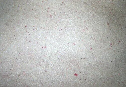 По фото определить сыпь на коже Жизнь взаперти и гиперграфия как главная улика Fishki.Net Дзен